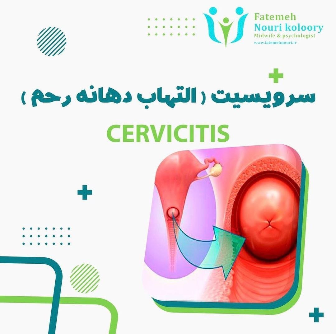 سرویسیت- التهاب دهانه رحم